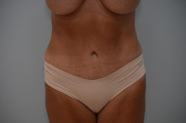 Mini Tummy Tuck after at JL Plastic Surgery in Newton, MA