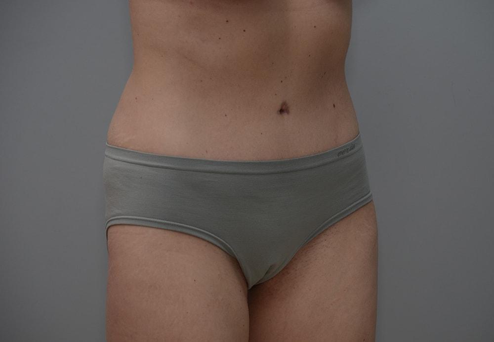 JL Plastic Surgery tummy tuck after — Newton, MA