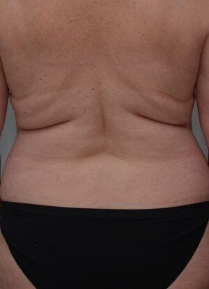 Liposuction before at JL Plastic Surgery in Newton, MA