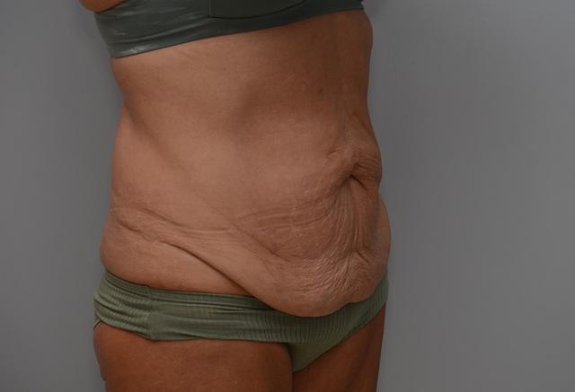 Mini Tummy Tuck before at JL Plastic Surgery in Newton, MA