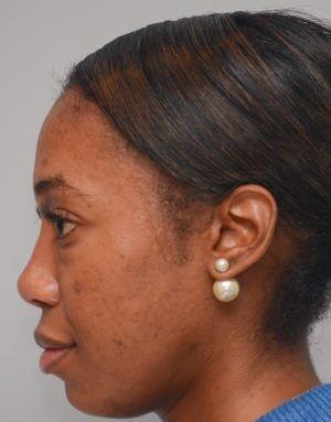 Rhinoplasty after at JL Plastic Surgery in Newton, MA