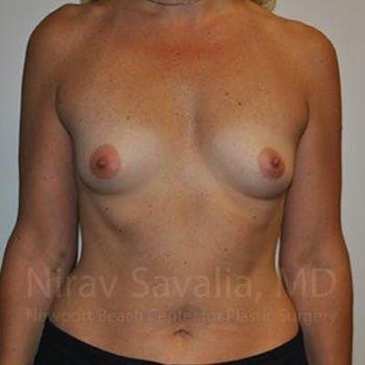 Breast Augmentation before at Savalia Plastic Surgery | Dr. Nirav Savalia in Newport Beach, CA