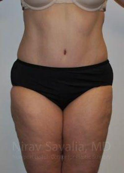 Tummy Tuck after at Savalia Plastic Surgery | Dr. Nirav Savalia in Newport Beach, CA