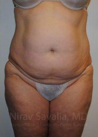 Tummy Tuck before at Savalia Plastic Surgery | Dr. Nirav Savalia in Newport Beach, CA