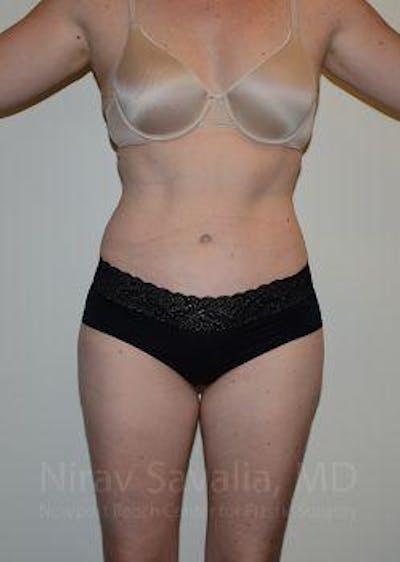 Savalia Plastic Surgery | Dr. Nirav Savalia tummy tuck after — Newport Beach, CA