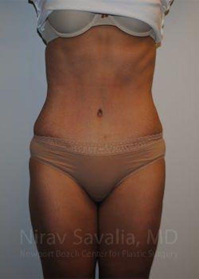 Savalia Plastic Surgery | Dr. Nirav Savalia tummy tuck after — Newport Beach, CA