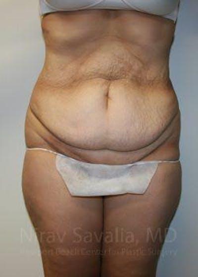 Tummy Tuck before at Savalia Plastic Surgery | Dr. Nirav Savalia in Newport Beach, CA