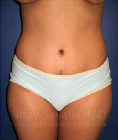 Tummy Tuck after at Savalia Plastic Surgery | Dr. Nirav Savalia in Newport Beach, CA