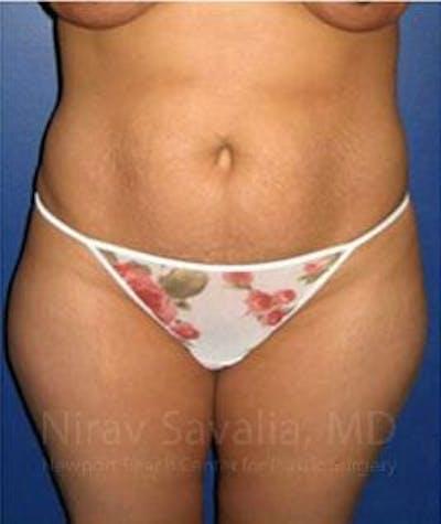 Tummy Tuck before at Savalia Plastic Surgery | Dr. Nirav Savalia in Newport Beach, CA