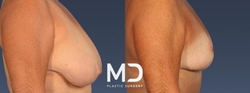 MD Plastic Surgery breast reduction result — Scottsdale, AZ