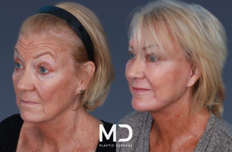 MD Plastic Surgery fat transfer result — Scottsdale, AZ