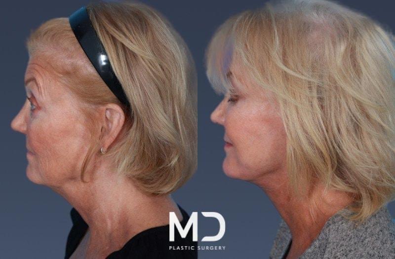 MD Plastic Surgery fat transfer result — Scottsdale, AZ