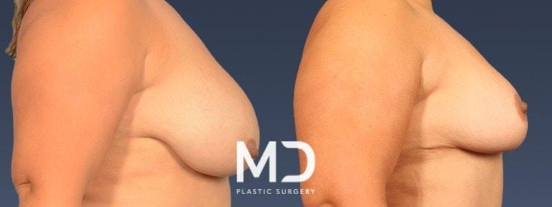 MD Plastic Surgery breast reduction result — Scottsdale, AZ