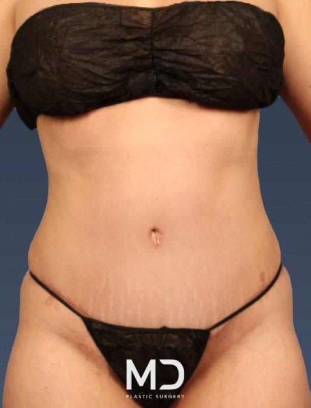 MD Plastic Surgery tummy tuck after — Scottsdale, AZ