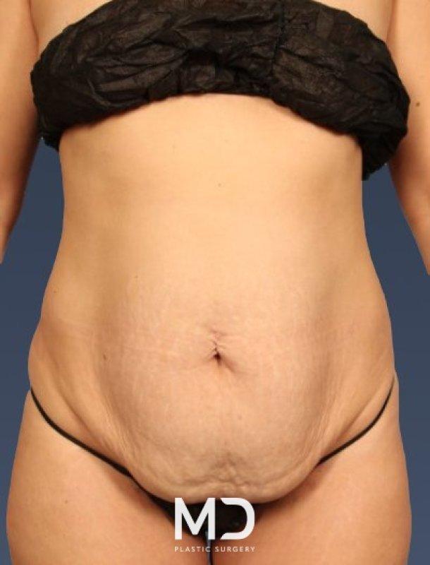 Tummy Tuck before at MD Plastic Surgery in Scottsdale, AZ