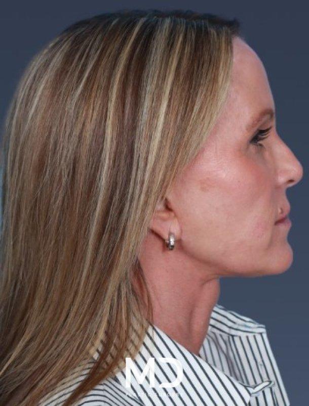 Neck Lift after at MD Plastic Surgery in Scottsdale, AZ