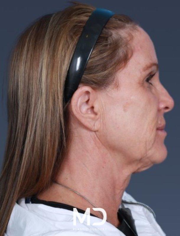 Neck Lift before at MD Plastic Surgery in Scottsdale, AZ