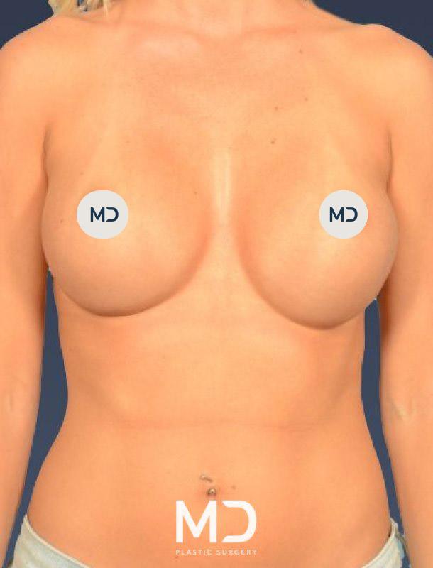 Breast Augmentation after at MD Plastic Surgery in Scottsdale, AZ