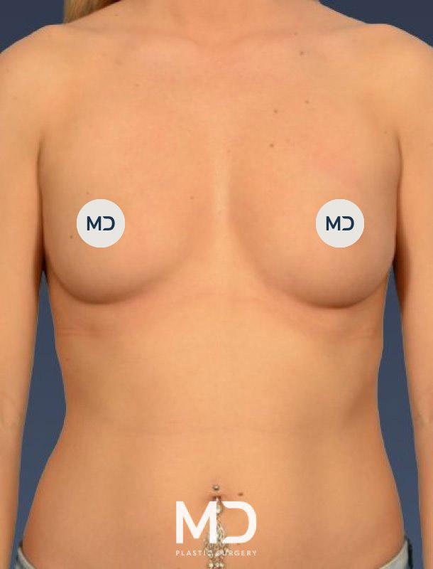 Breast Augmentation before at MD Plastic Surgery in Scottsdale, AZ