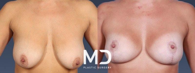 MD Plastic Surgery breast reduction result — Scottsdale, AZ