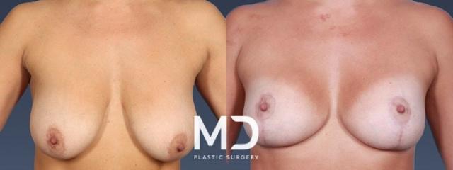 Breast Reduction result at MD Plastic Surgery in Scottsdale, AZ