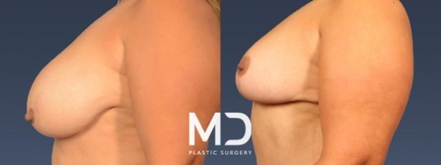 Breast Reduction result at MD Plastic Surgery in Scottsdale, AZ
