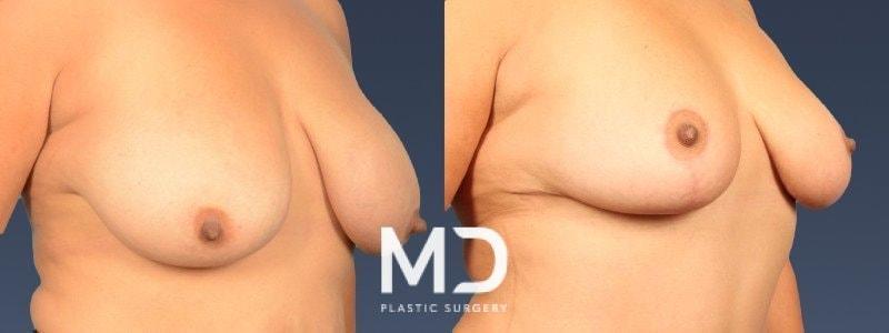 MD Plastic Surgery breast reduction result — Scottsdale, AZ