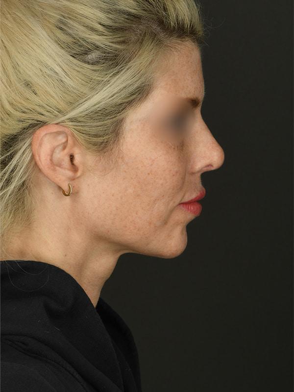 Dr. M.J. Trovato rhinoplasty after — Dallas, TX
