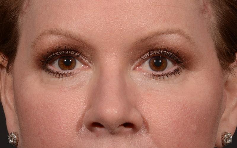 Dr. M.J. Trovato blepharoplasty after — Dallas, TX