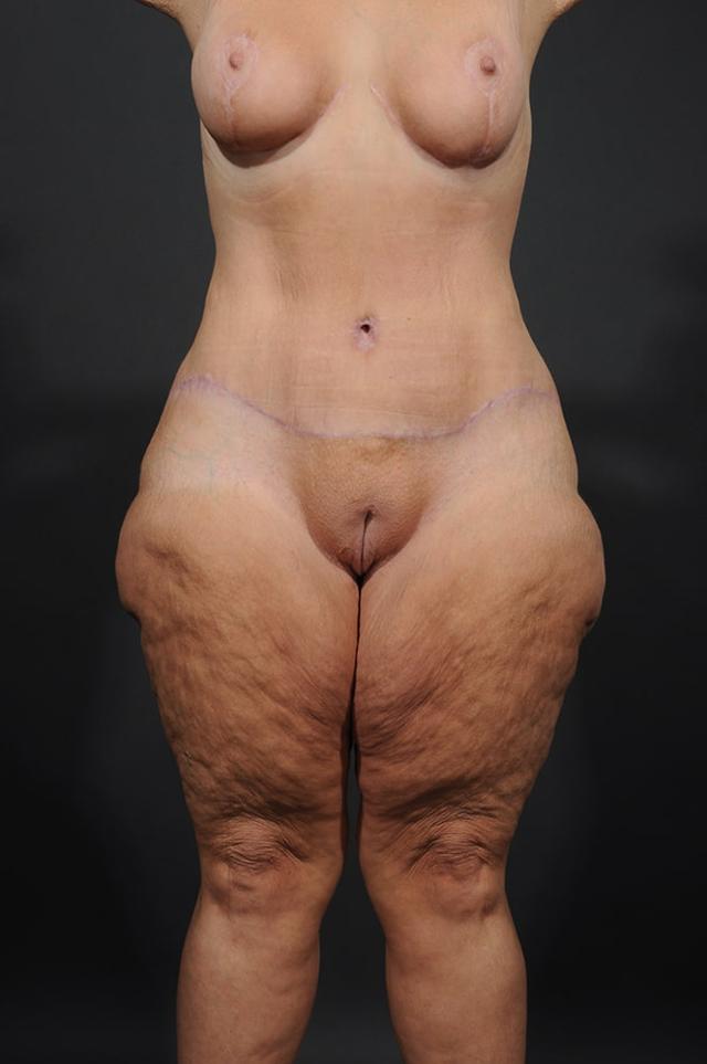 Mommy Makeover after at Dr. M.J. Trovato in Dallas, TX