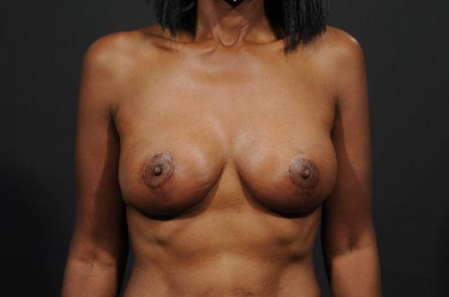 Breast Lift after at Dr. M.J. Trovato in Dallas, TX
