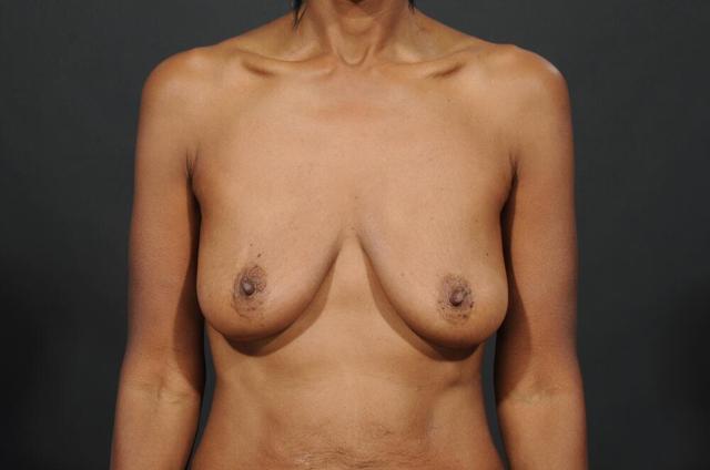 Breast Lift before at Dr. M.J. Trovato in Dallas, TX