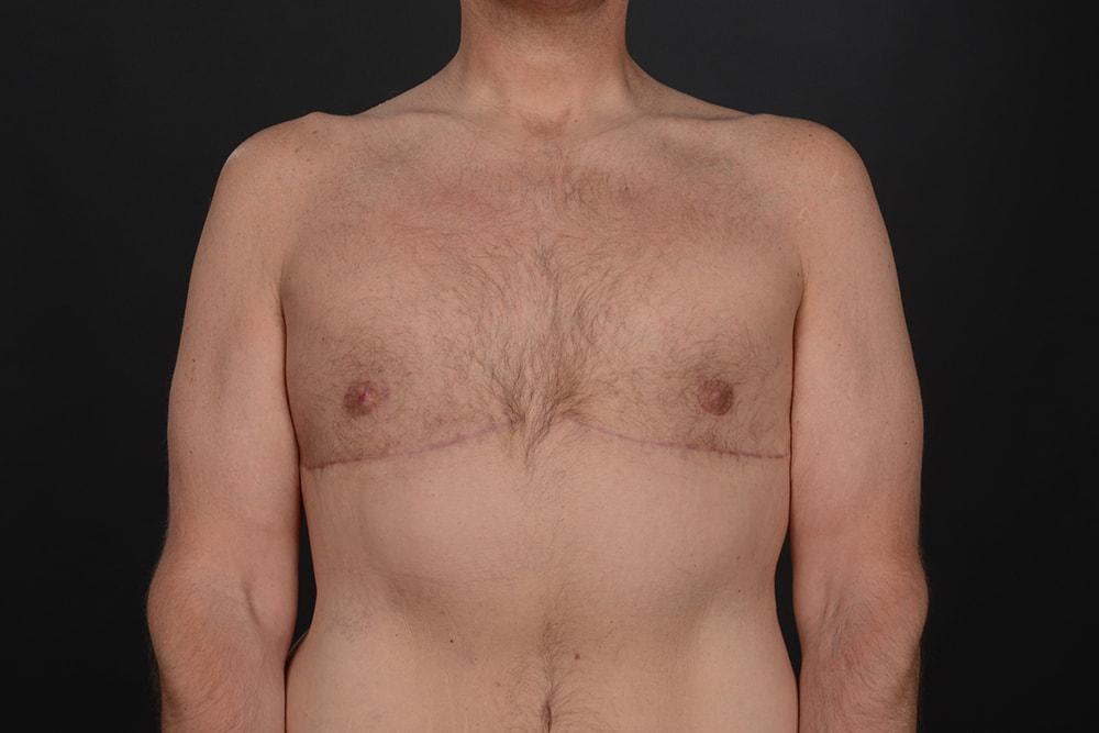 Dr. M.J. Trovato gynecomastia after — Dallas, TX