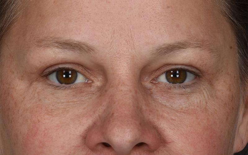 Dr. M.J. Trovato blepharoplasty after — Dallas, TX