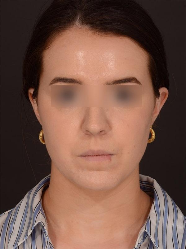 Chin Implant after at Dr. M.J. Trovato in Dallas, TX