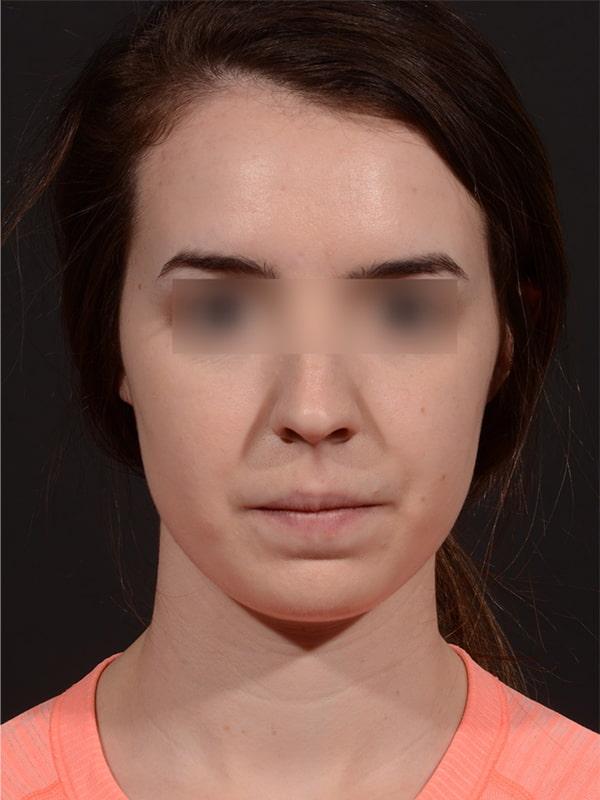 Chin Implant before at Dr. M.J. Trovato in Dallas, TX