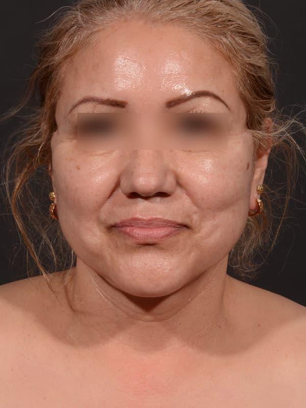 Dr. M.J. Trovato facelift after — Dallas, TX