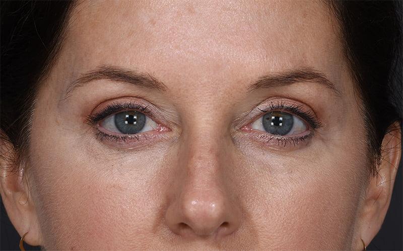 Dr. M.J. Trovato blepharoplasty after — Dallas, TX