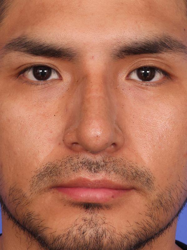 Dr. M.J. Trovato rhinoplasty after — Dallas, TX