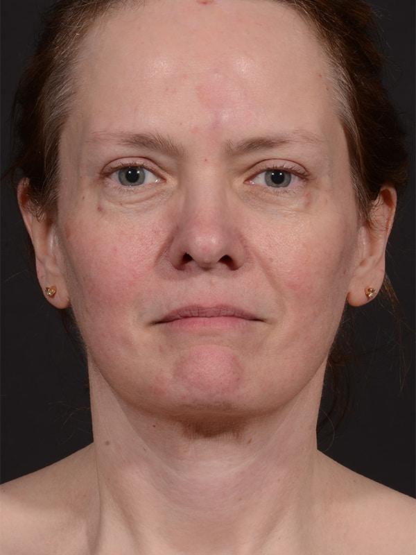 Neck Lift after at Dr. M.J. Trovato in Dallas, TX
