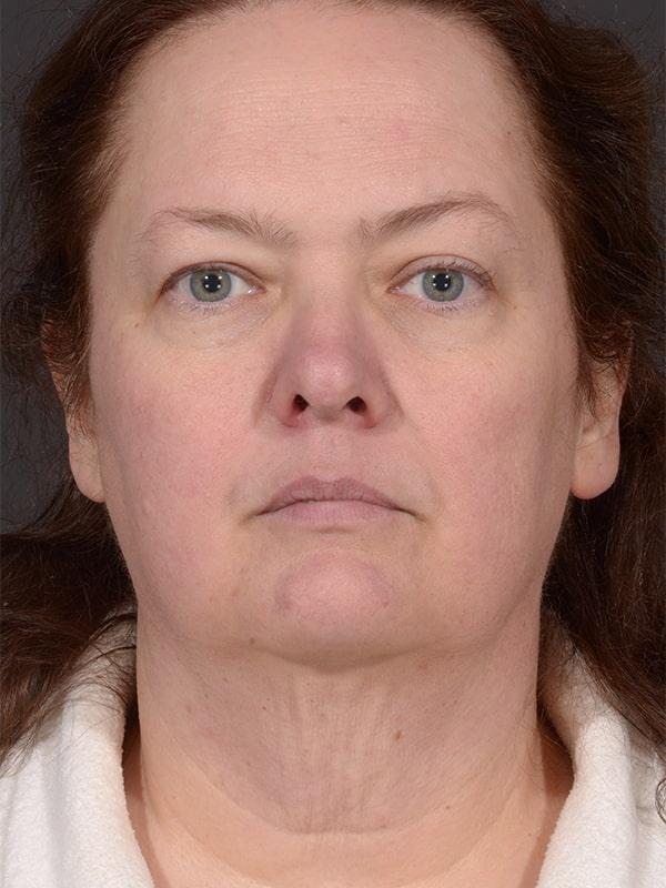 Neck Lift before at Dr. M.J. Trovato in Dallas, TX