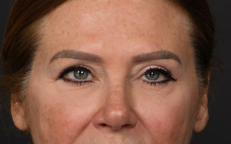 Dr. M.J. Trovato blepharoplasty after — Dallas, TX