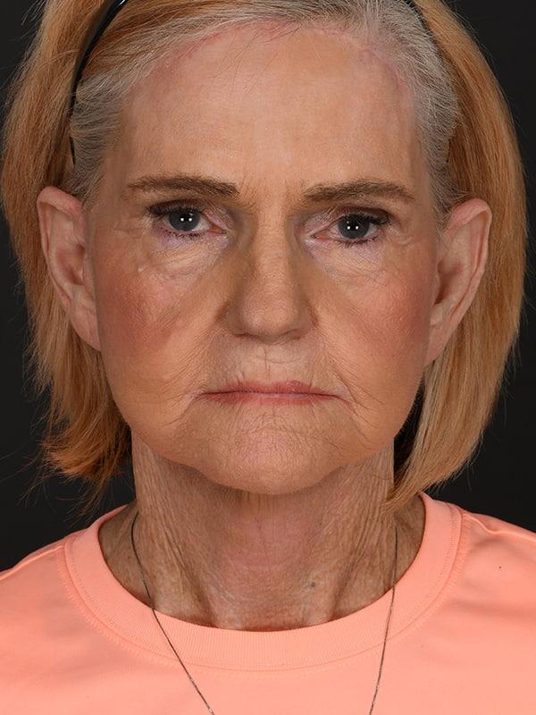 Dr. M.J. Trovato facelift after — Dallas, TX
