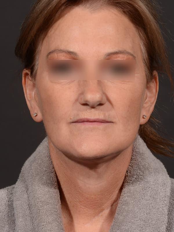Dr. M.J. Trovato facelift after — Dallas, TX