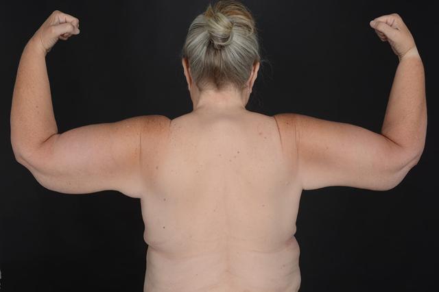 Arm Lift after at Dr. M.J. Trovato in Dallas, TX