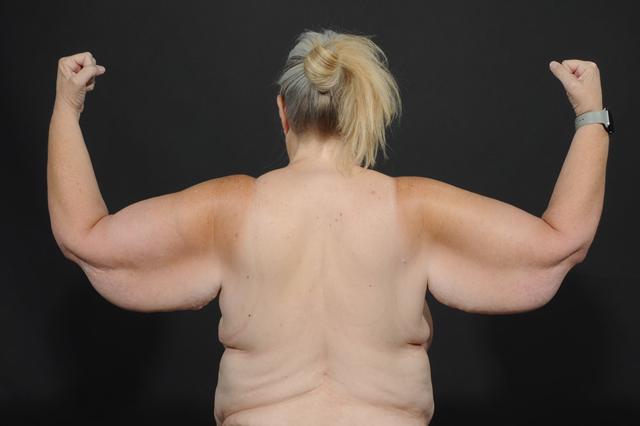 Arm Lift before at Dr. M.J. Trovato in Dallas, TX