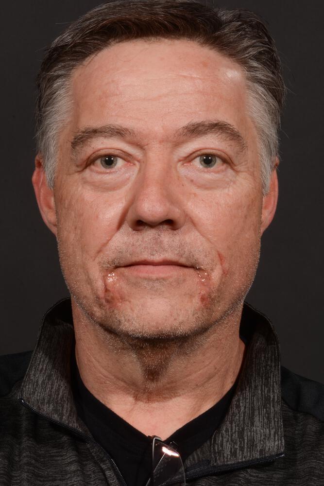 Dr. M.J. Trovato blepharoplasty after — Dallas, TX