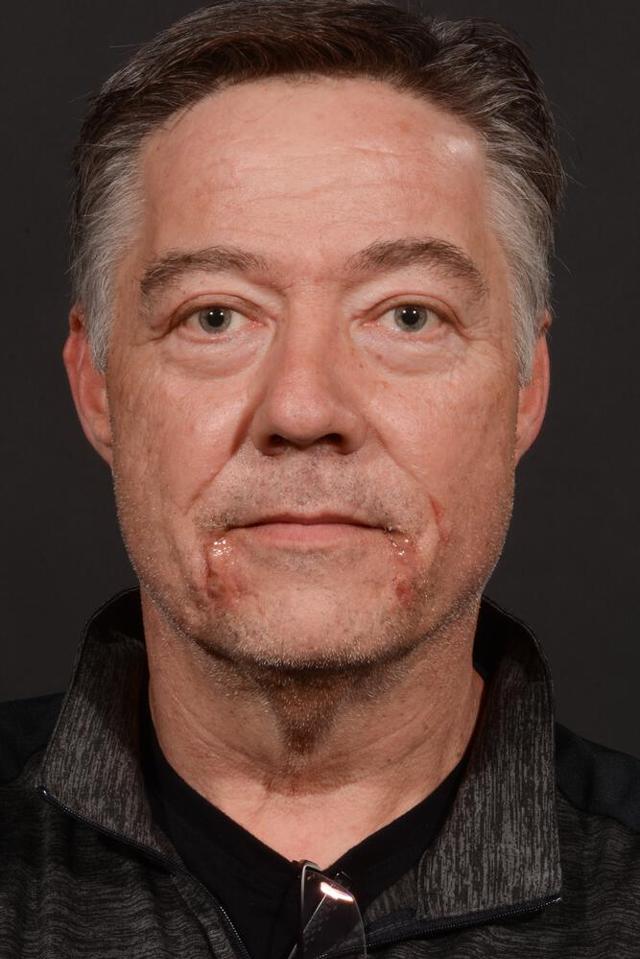 Blepharoplasty after at Dr. M.J. Trovato in Dallas, TX