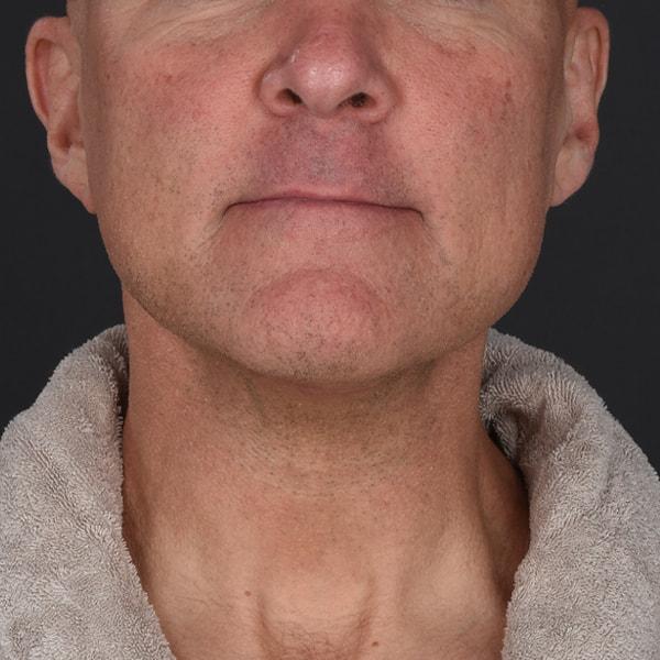 Neck Lift after at Dr. M.J. Trovato in Dallas, TX