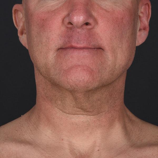 Neck Lift before at Dr. M.J. Trovato in Dallas, TX